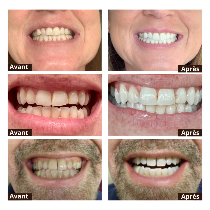BodyAccel™ – Denti più bianchi in 7 giorni